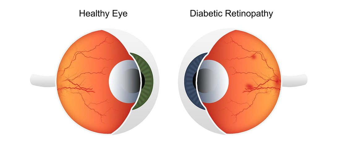Diabetes and the eye
